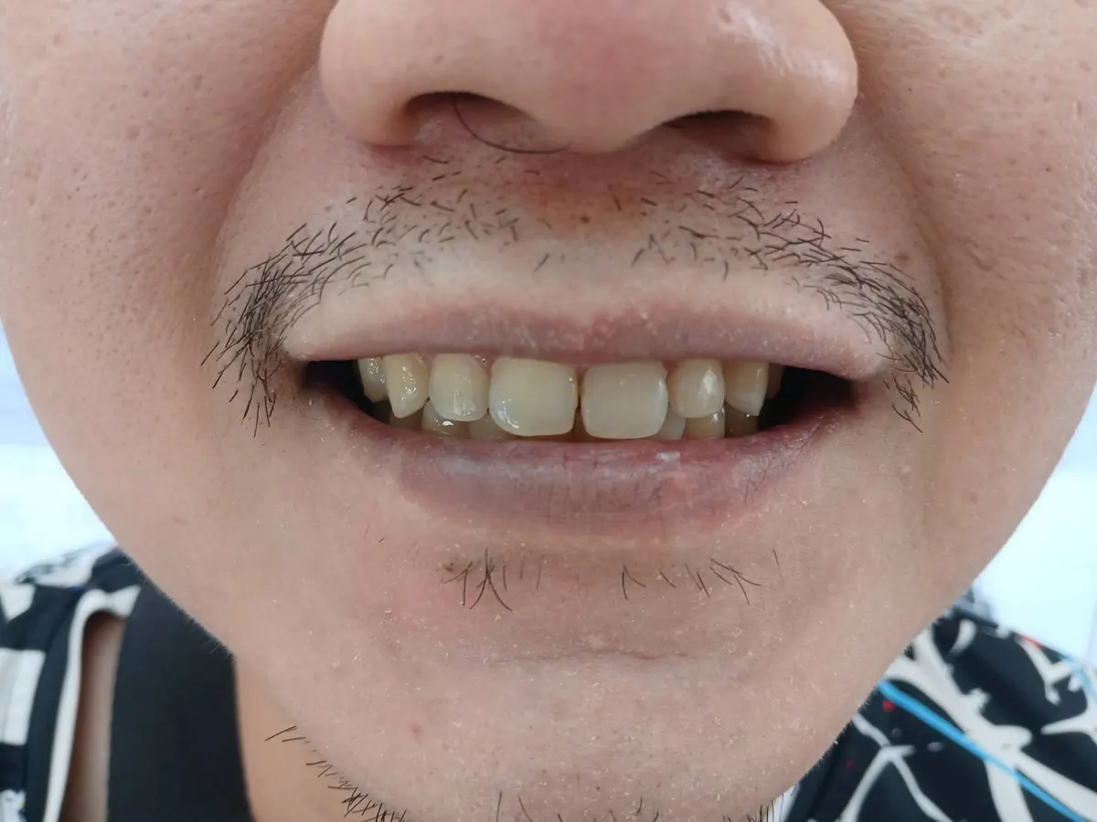 อุดฟัน