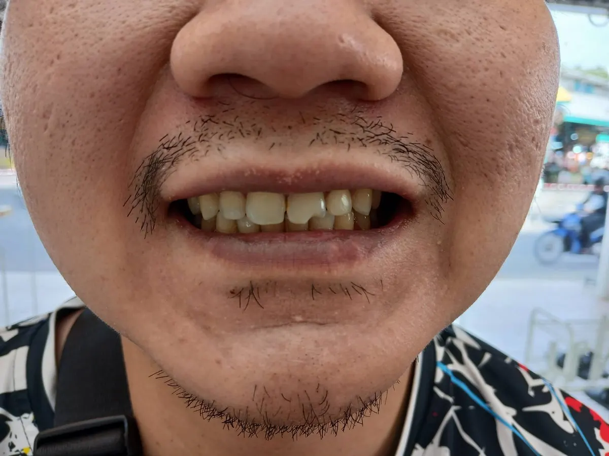 อุดฟัน