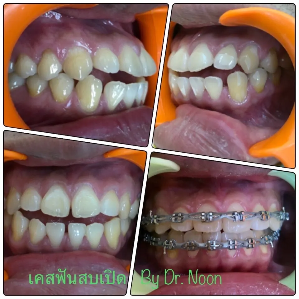 จัดฟัน