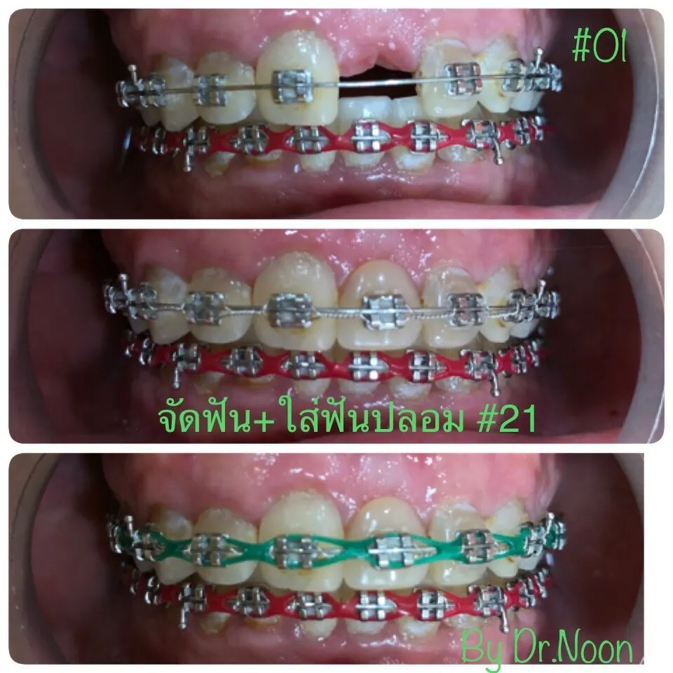จัดฟัน