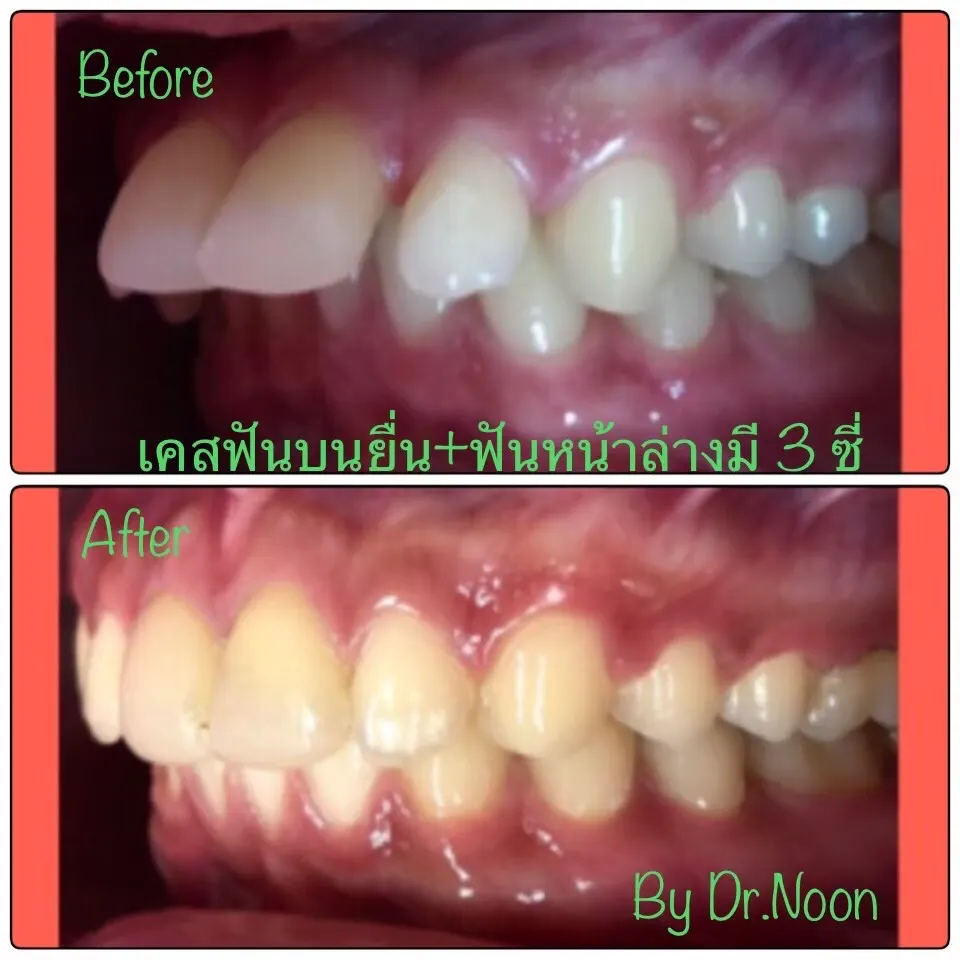 จัดฟัน