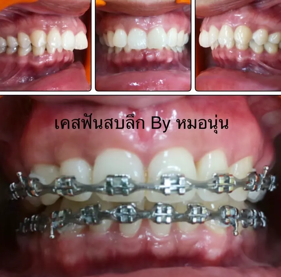จัดฟัน