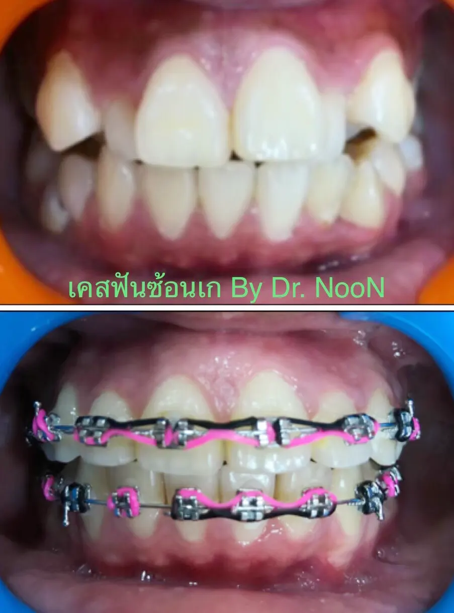 จัดฟัน